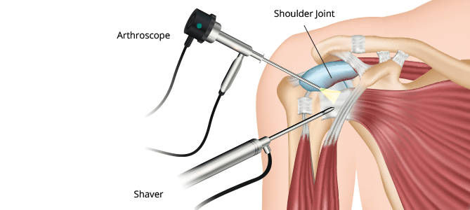 Shoulder Arthroscopy in Bangalore