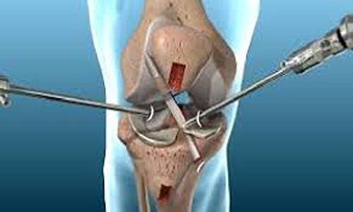 How to Choose the Right Surgeon for ACL Reconstruction in Bangalore