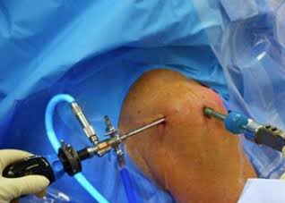 Indications for Shoulder Arthroscopy