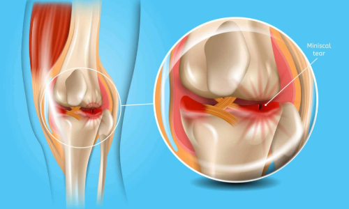 Innovations in Meniscus Repair: What Patients Need to Know