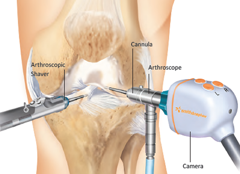 Knee Arthroscopy Dr Nataraj H M