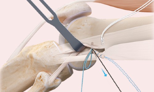 Lateral Extra-Articular Tenodesis (LET) with ACL Reconstruction: Advanced Knee Stability Surgery for Athletes in Bangalore