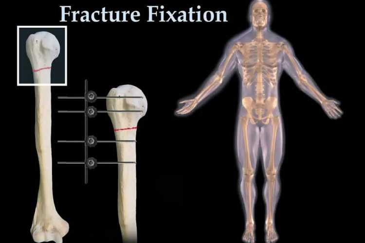 Shoulder Fracture Fixation