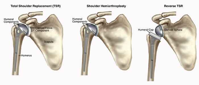 shoulder Replacement surgery in Bangalore