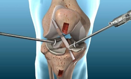 Things People Should Know About ACL Surgery