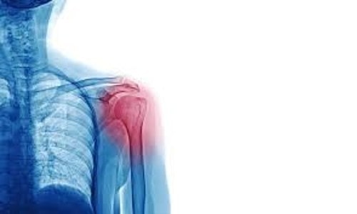 What is a fractured (broken) shoulder?