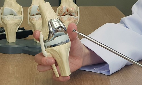 When Do You Need a Knee Replacement? Top Bangalore Surgeons Explain